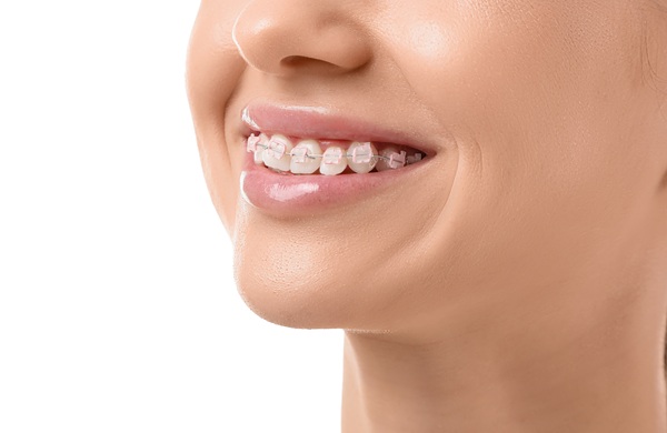 Clear Braces Vs  Aligners:   Important Differences To Keep In Mind