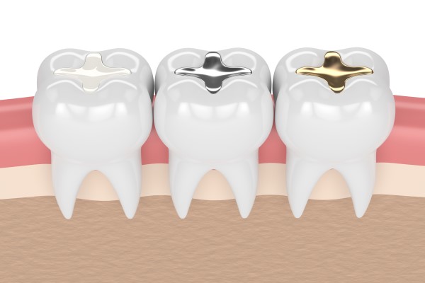 What Materials Are Used In Dental Fillings?