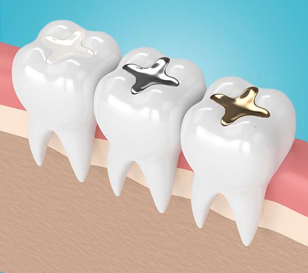 Pasadena Composite Fillings