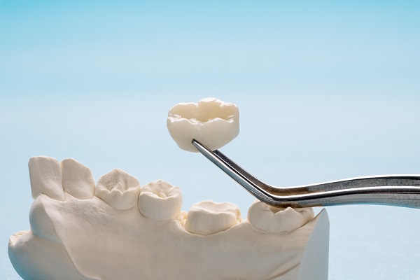 Does A Dental Crown Protect Your Tooth?