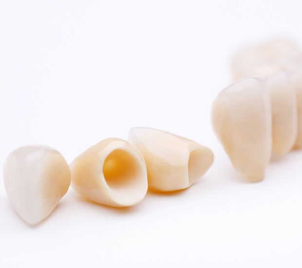 Pasadena Dental Crowns and Dental Bridges