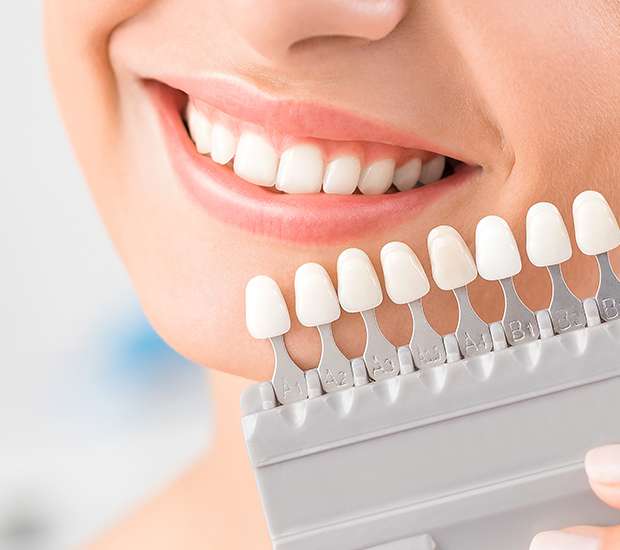 Pasadena Dental Veneers and Dental Laminates