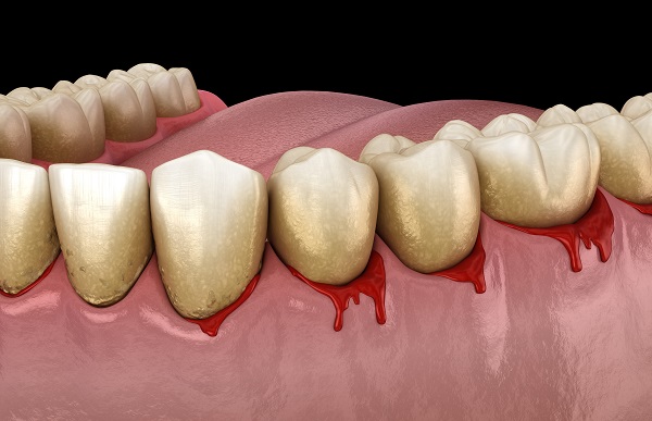 Common Signs Of Gum Disease Karrie Chu Dds Dental Care Pasadena