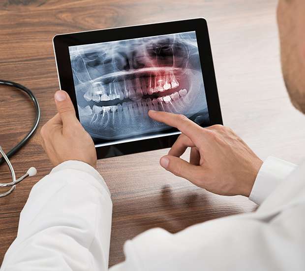 Pasadena Types of Dental Root Fractures