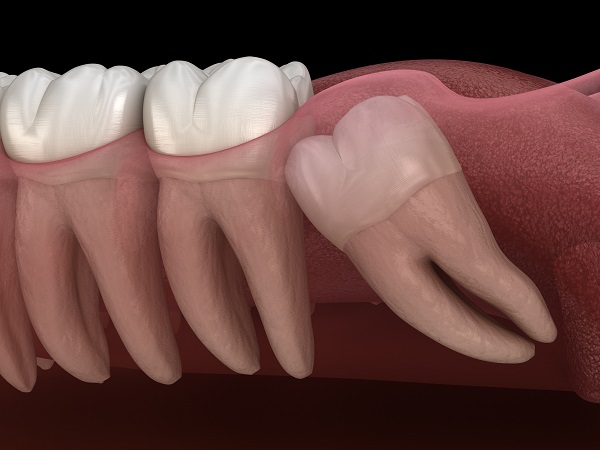 wisdom tooth extraction Pasadena, CA